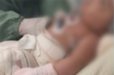 Roncador: Criança sofre queimaduras graves pelo corpo