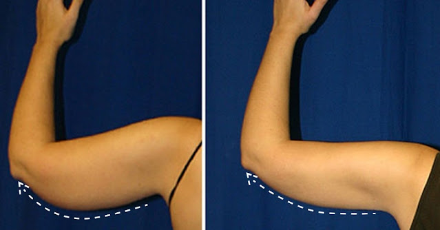 5 façons de tonifier les bras flasques sans routine d'exercice ni poids