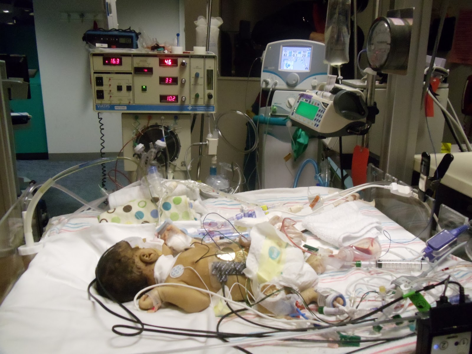 Maddox Torry Maddox coming off ECMO... April 5, 2011