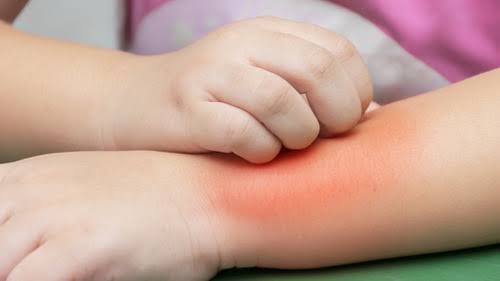 Kenali Eksim Atopic Alergi Pada Anak Dan Cara Mengatasinya