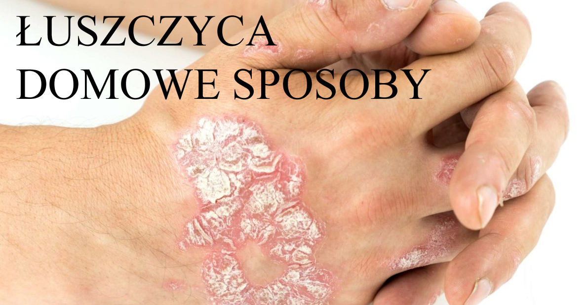 10 sposobów na leczenie łuszczycy w domu Zioła na łuszczyce
