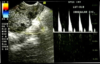 Doppler ultrasound in gynaecology and obstetrics