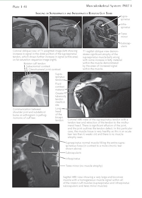 Imaging Of Supraspinatus And Infraspinatus Rotator Cuff Tears