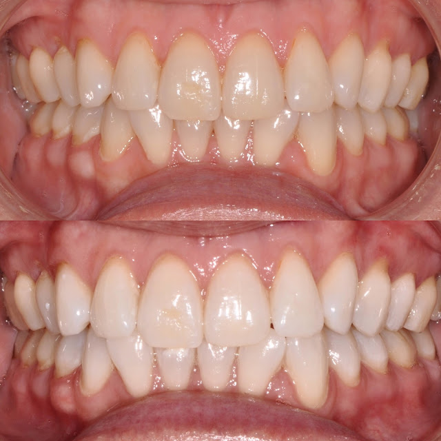 My Philips ZOOM! Teeth Whitening experience with before and after!