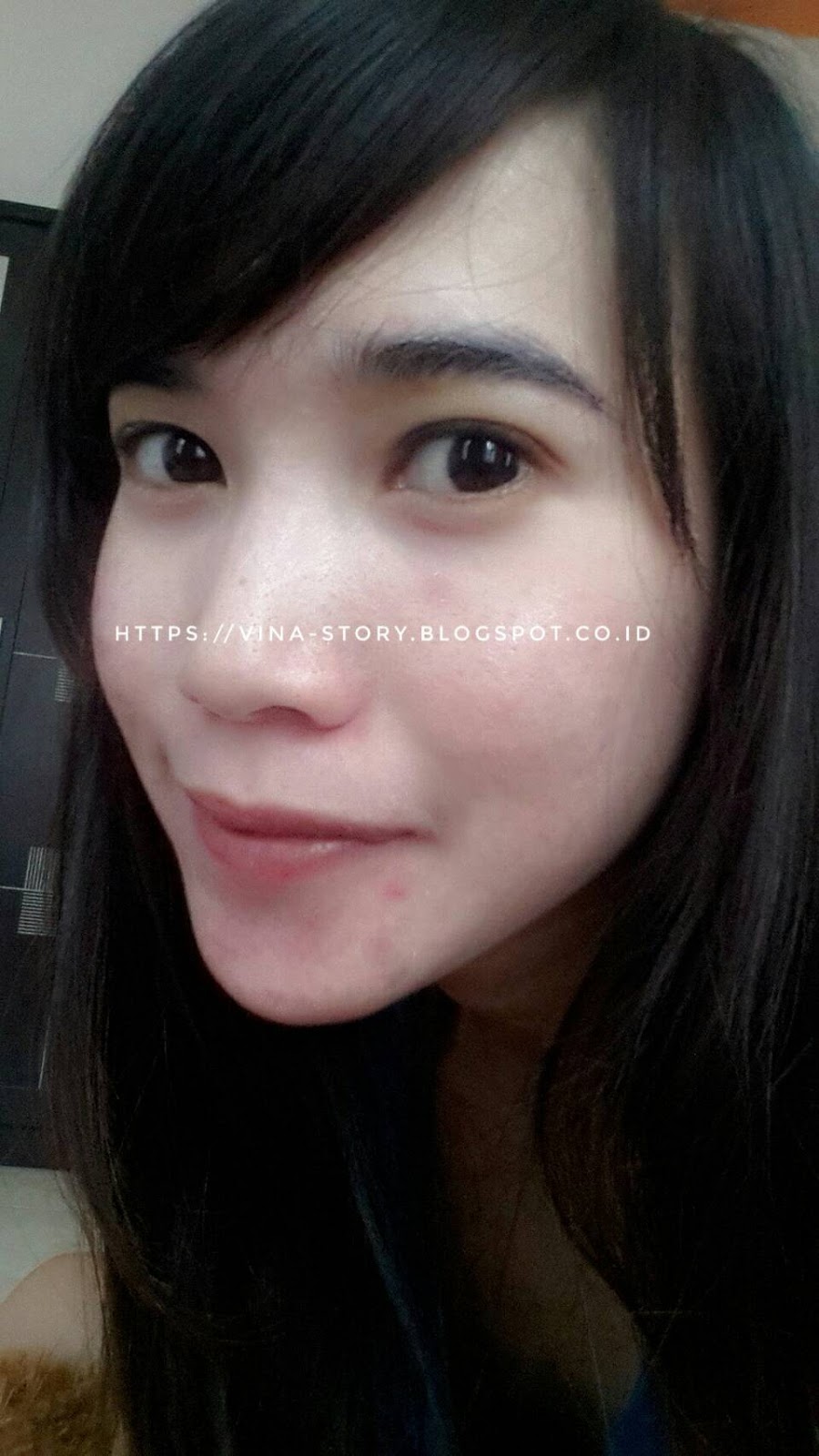 Mommies Beauties Journal Pengalaman Lepas Krim Dokter Atau Perawatan Di Dokter Spkk Breakout Trial Error Purging Acne Fight Survive Part 1