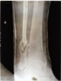 X-ray of Josef Jakob's broken leg - frontal view (screen capture of National Archives) X-ray of Josef Jakob's broken leg - frontal view (screen capture of National Archives)