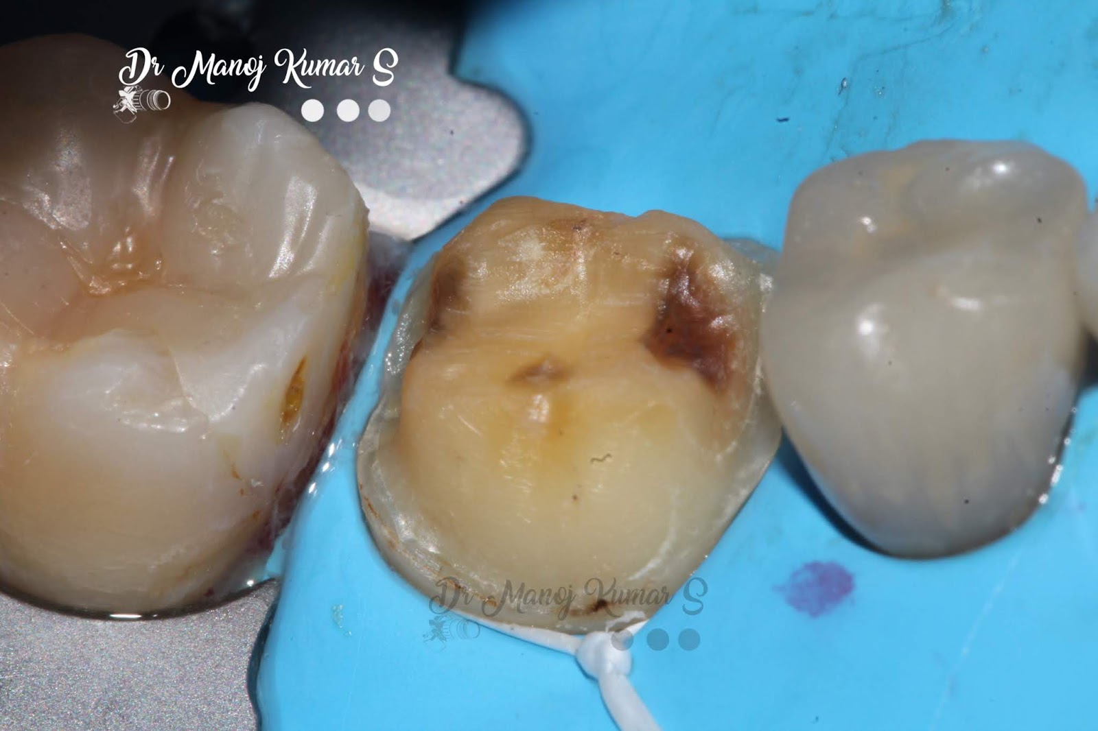 Case 45 Cementation protocol for an emax lithium disilicate crown