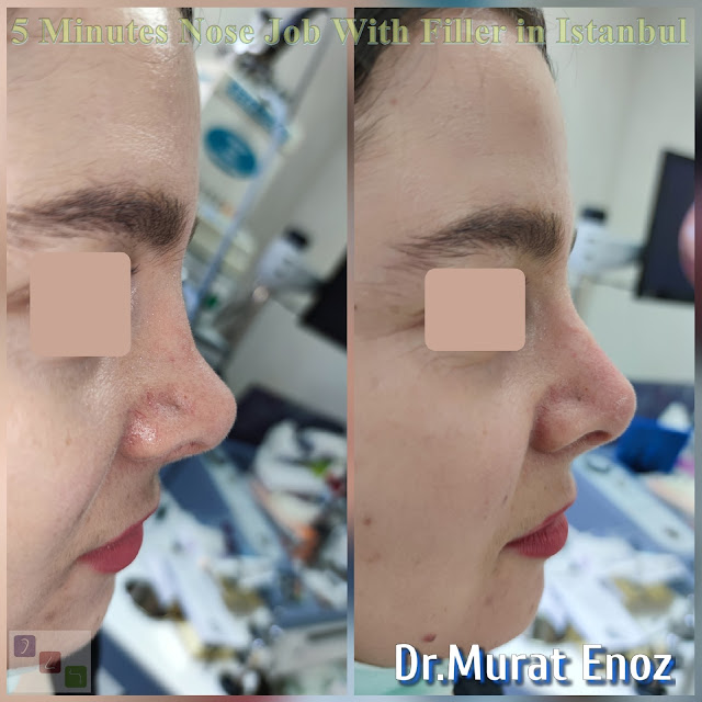 The 5 Minute Nose Job in Istanbul,Nose filler injection Turkey,