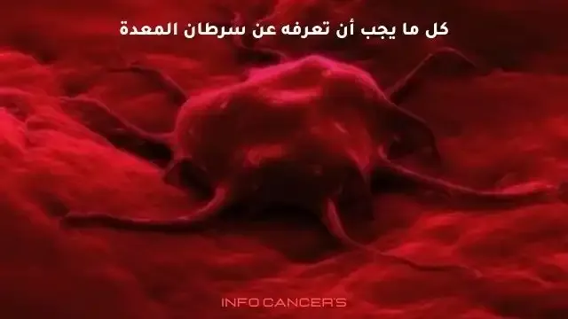 سرطان المعدة  ورم خبيث ينمو في خلايا المعدة