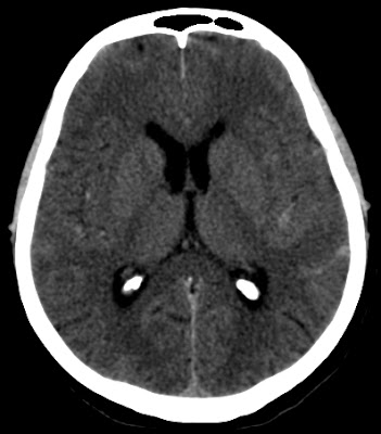 Subarachnoidal hemorrhage