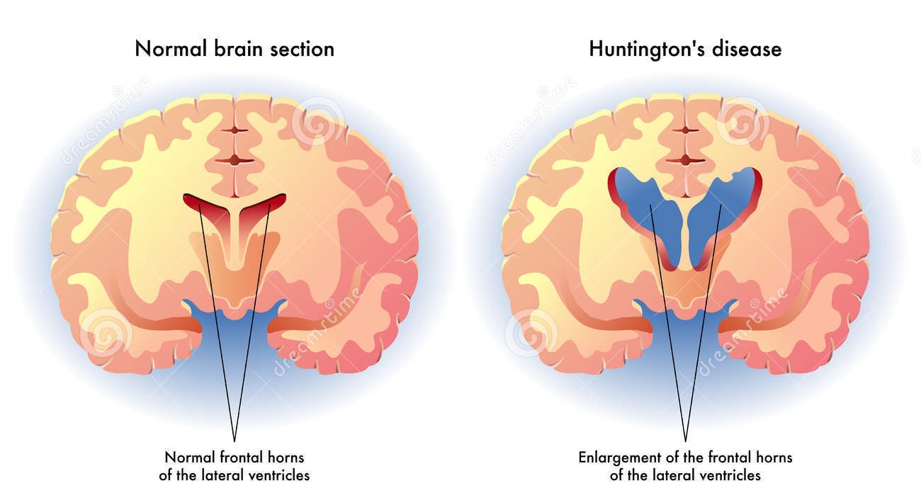 My Family Medicine Practice Huntington’s Disease