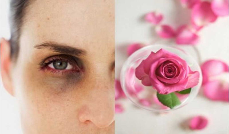 Use Rosewater 5 Ways to Get Rid of Dark Circles Naturally