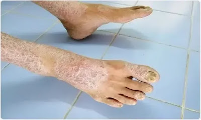 تصلب الجلد مرض جلدي
