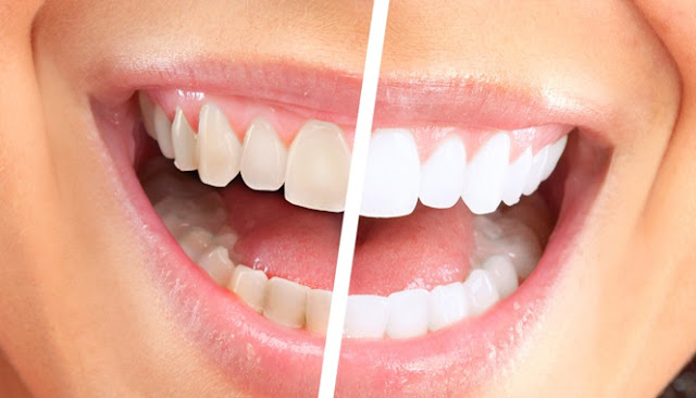 How To Remove Coffee, Smoking, Drinks And Other Stains From Your Teeth Permanently