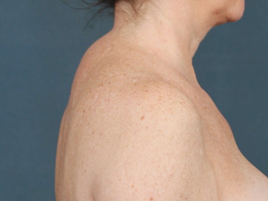 Buffalo Hump On Neck Endocrine Caraway Seeds Health Benefits