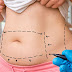 7 Side effects that you can face after liposuction