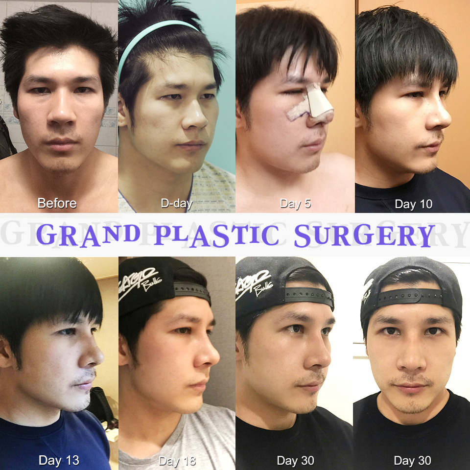 [Grand Plastic Surgery Real Review] Korean Plastic Surgery before and after double eyelids