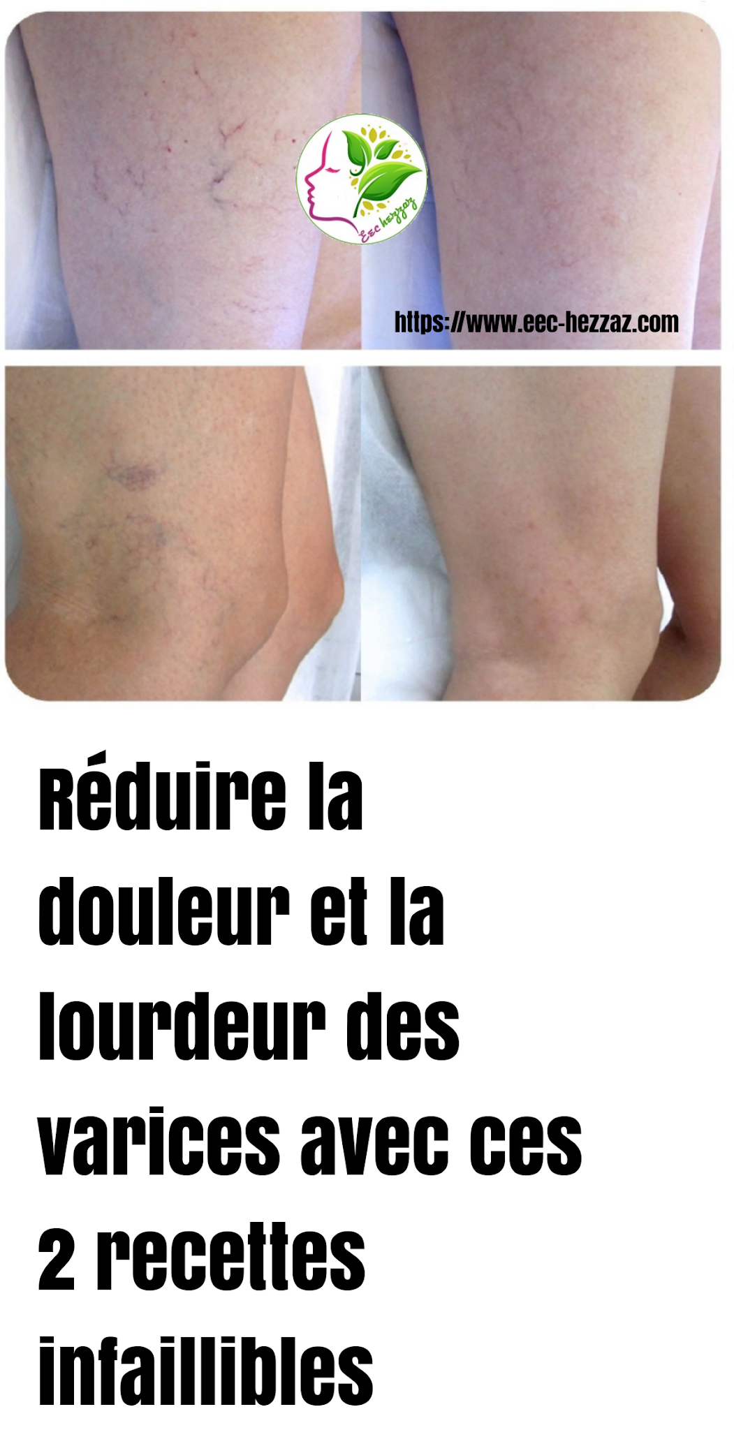 Réduire la douleur et la lourdeur des varices avec ces 2 recettes infaillibles