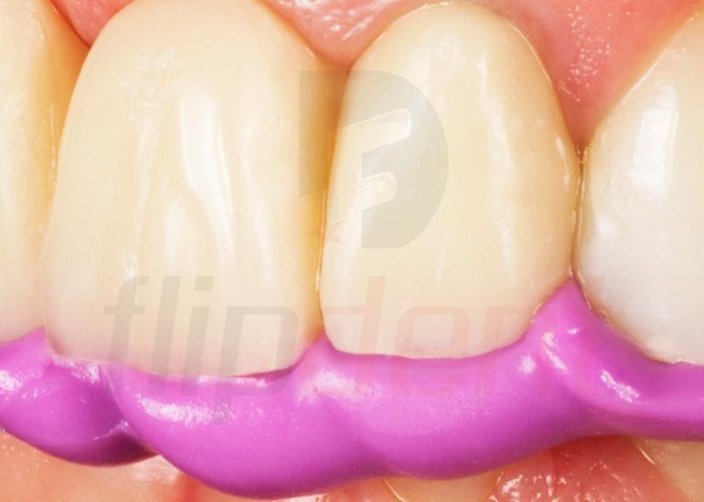 Fixed bite registration (9)