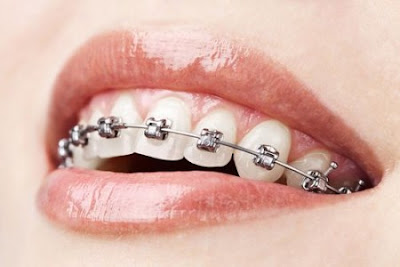 Niềng răng mắc cài inox giá bao nhiêu?