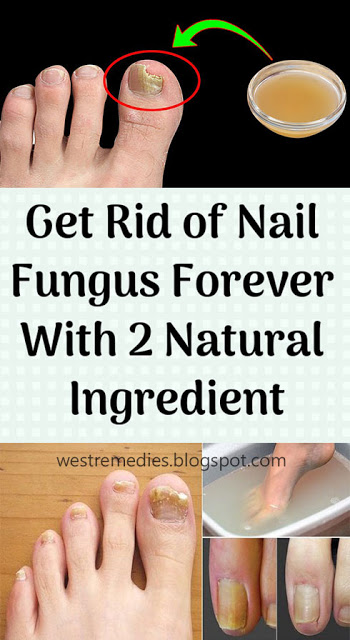 Get Rid of Nail Fungus Forever – 2 Ingredient Recipe | Wellness Guru