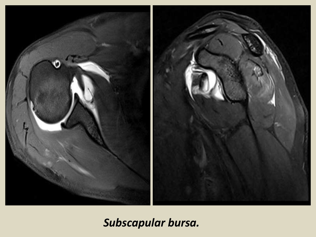 MRI MusculoSkeletal Section Bursa of shoulder.