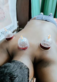 Cupping Therapy Benefits and Side Effects