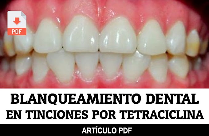 PDF: Blanqueamiento dental en tinciones por Tetraciclina