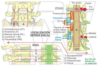 Localización hernia discal