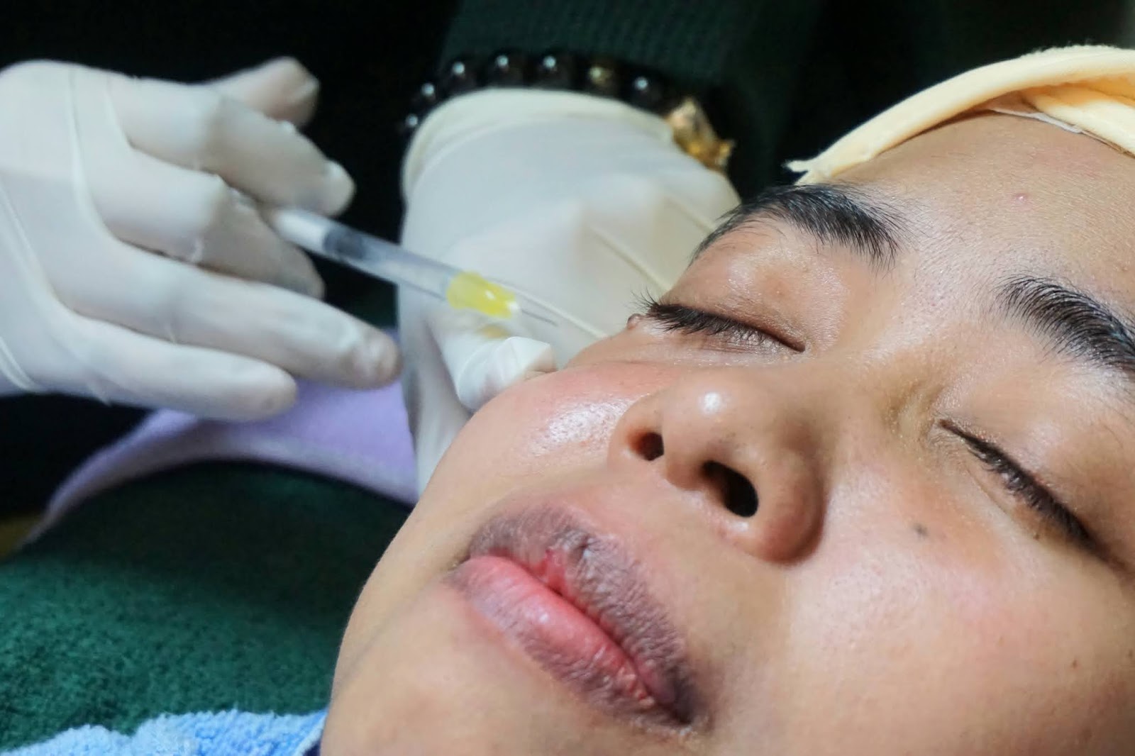 Buang Tahi Lalat Hidup Dan Bulu Halus Di Bahagian Muka Guna Kaedah