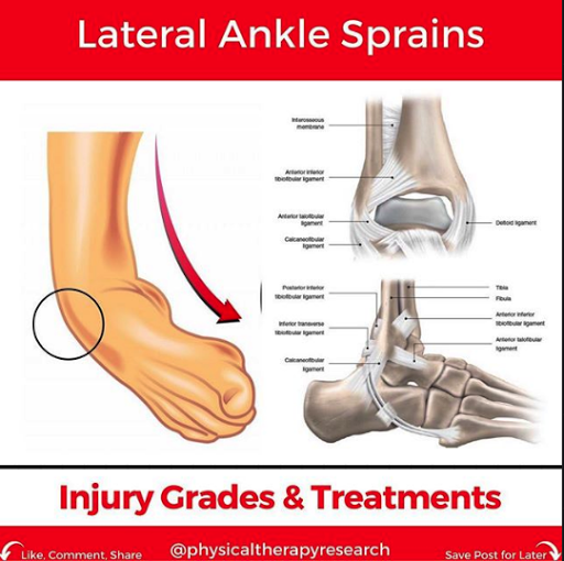 Lateral Ankle Sprains: Injury & Treatments | Modern Manual Therapy Blog
