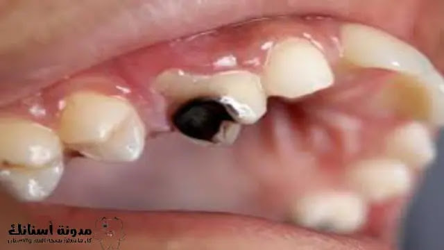 تسوس الأسنان: أسبابه، أعراضه وطرق علاجه.