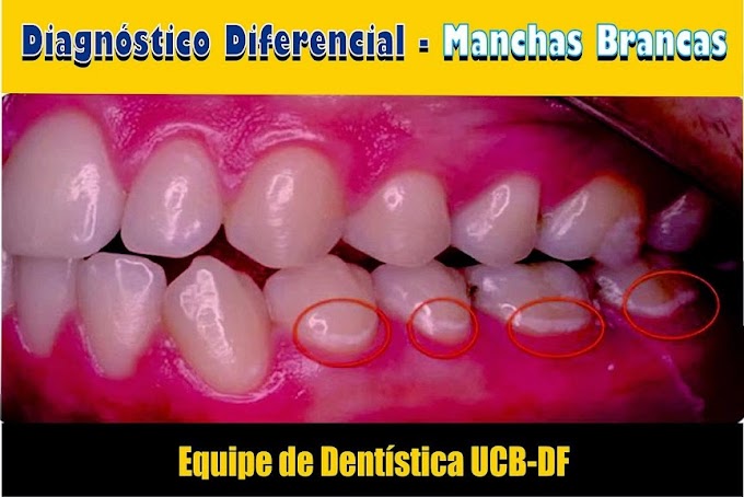 MANCHAS BRANCAS: Diagnóstico Diferencial - Gustavo Rivera