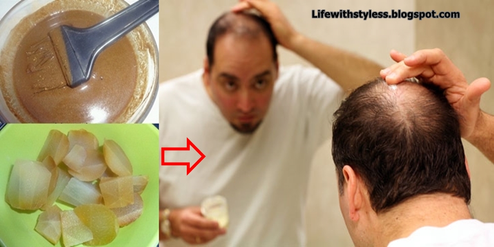 Best Hair Packs For Hair Loss Life With Styles