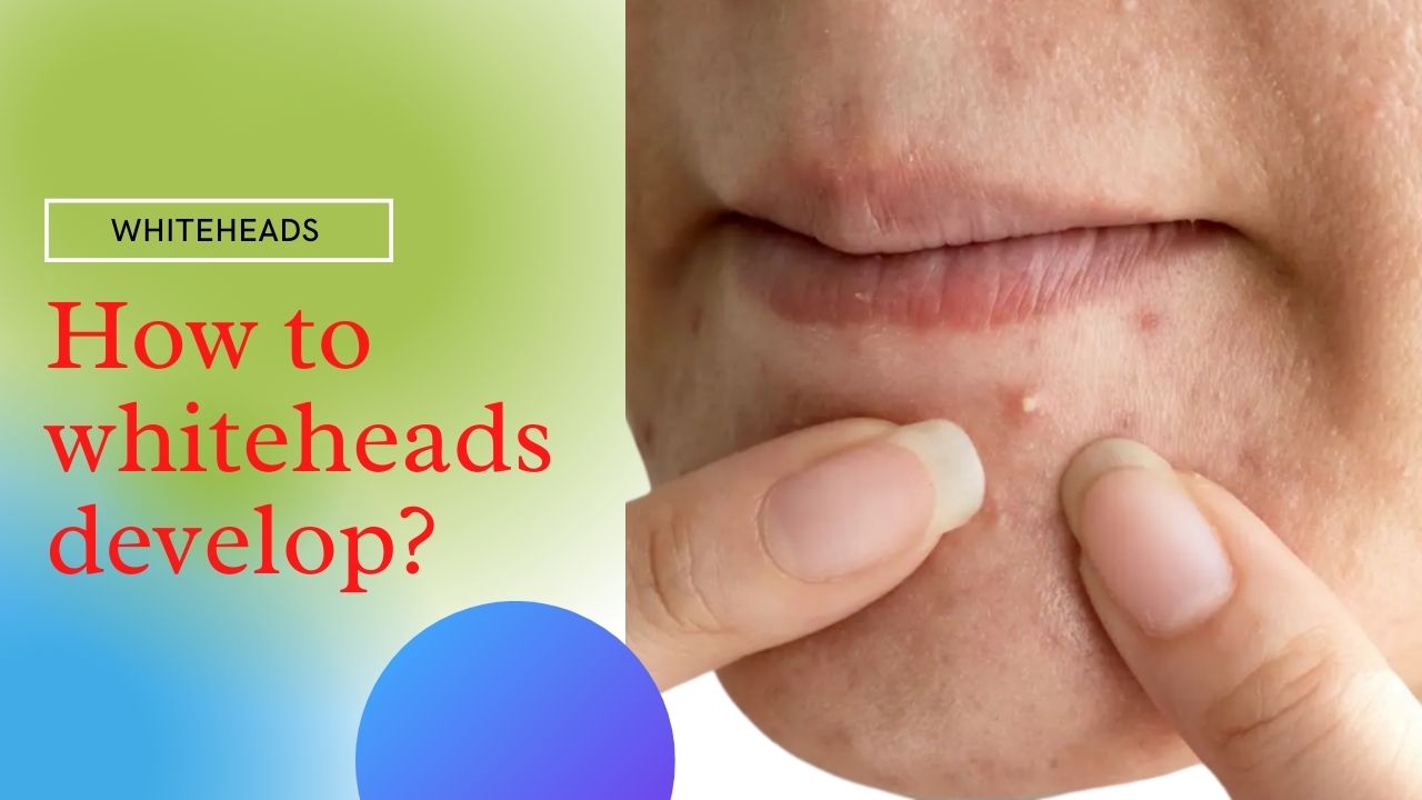 whiteheads-causes-how-to-get-rid-of-whiteheads-naturally-2020