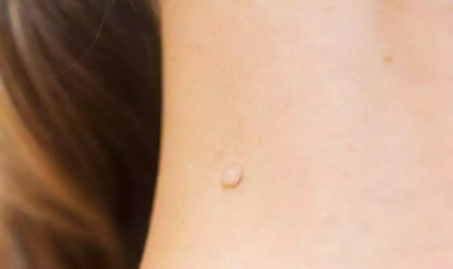 How to remove Skin Tags