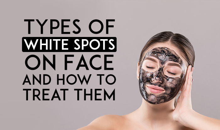 Types Of White Spots On Face And How To Treat Them
