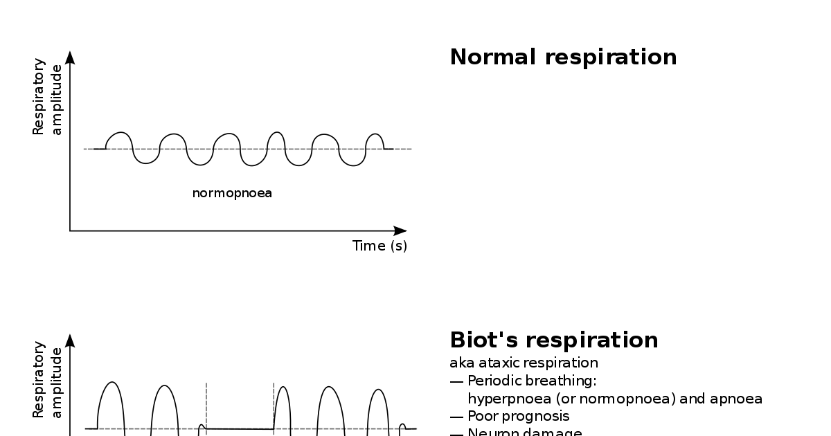 Listen Carefully to Differentiate b/w Kussmaul Breathing, Biot's Respiration & Cheyne-Stokes ...
