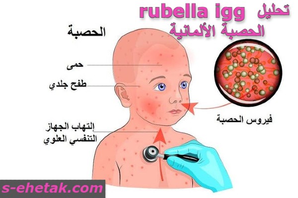 ما هو ﺗﺣﻠﯾل rubella igg الحصبة الالمانية؟