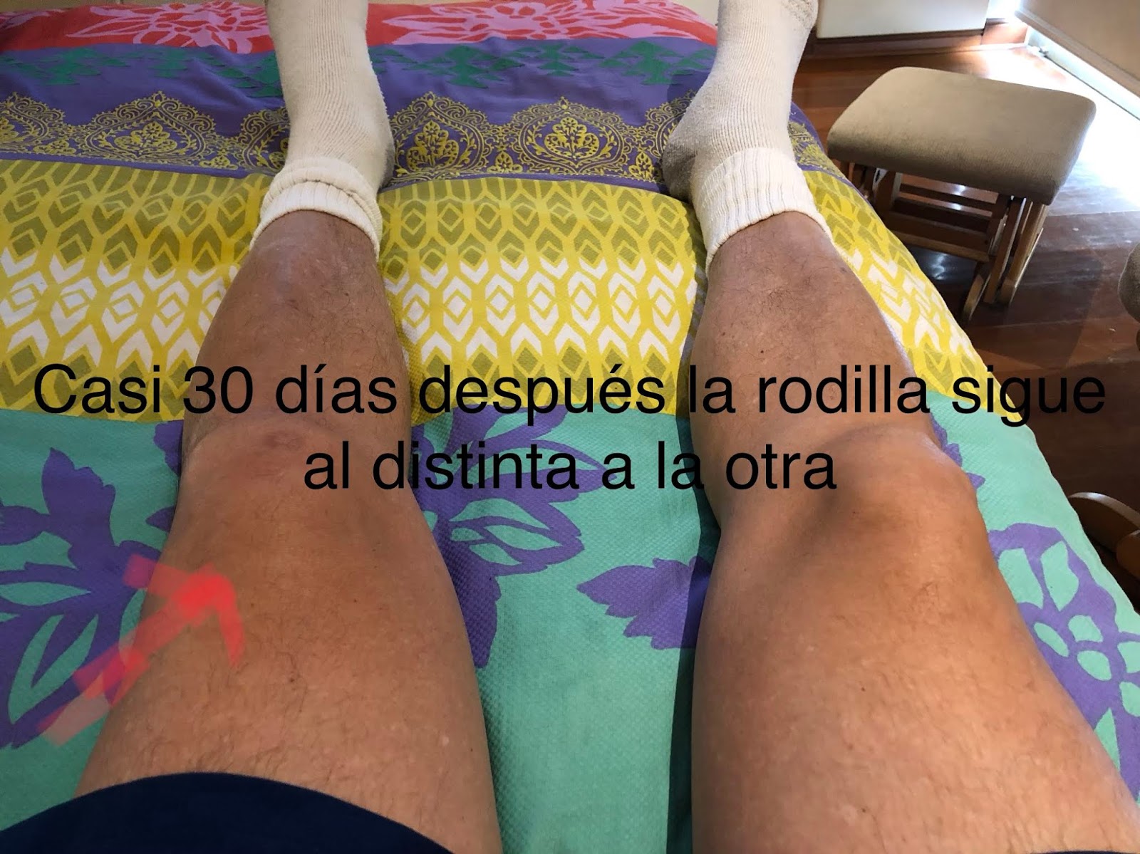 En escaleras al solo la subir dolor rodilla