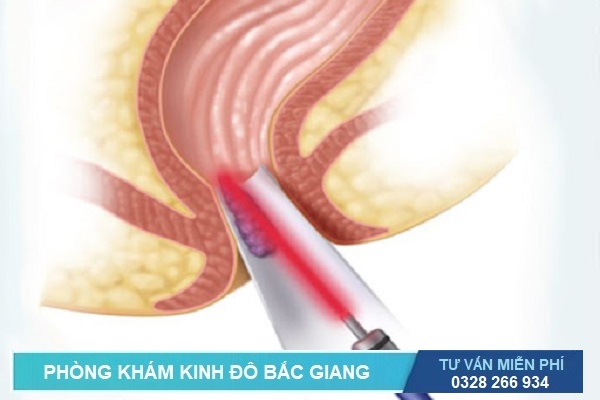 cách chữa bệnh trĩ bằng phương pháp cắt trĩ