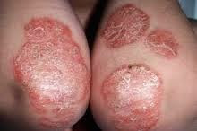 Tips Cepat Dan Tepat Mengatasi Eksim Atau Dermatitis