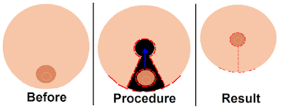 Pendulous breasts Definition, Breast Feeding, Lift, Large Pendulous breasts