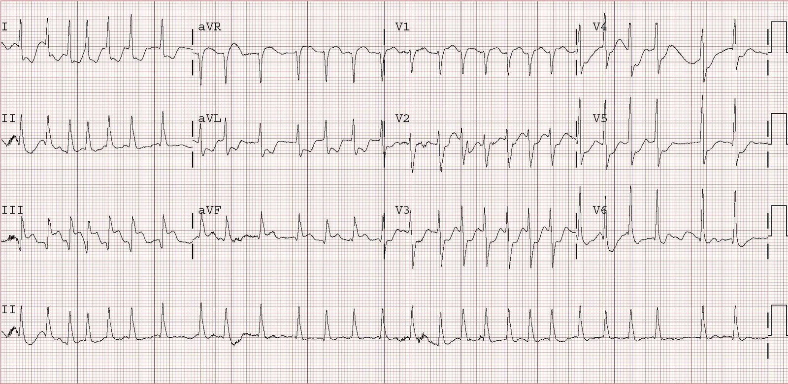 atrial fibrillation ivcd atrial fibrillation ivcd