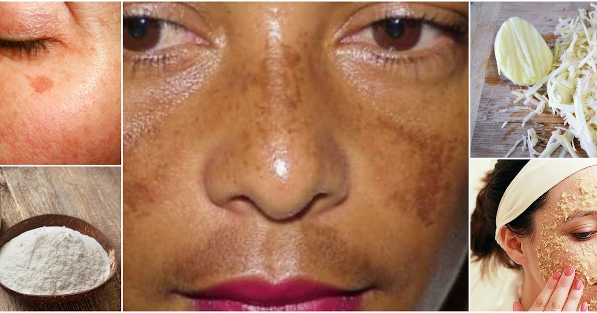 Haz esta mascarilla de papa y elimina las manchas de tu