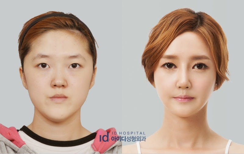 best double eyelid surgeon in korea.