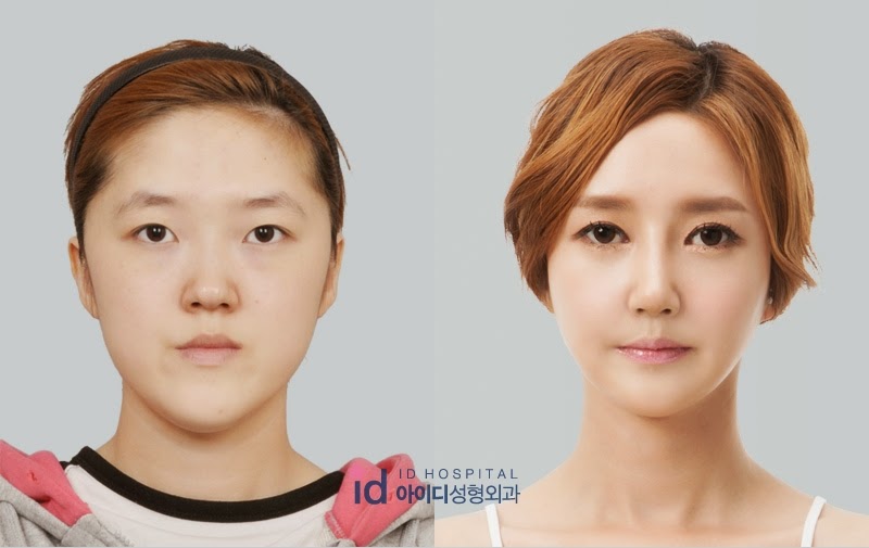 ID Hospital Korea best double eyelid surgeon in korea