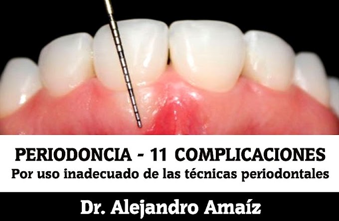 PERIODONCIA: 11 complicaciones por uso inadecuado de las técnicas periodontales