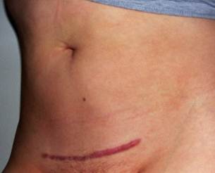 Karena 3 Fakta Ini Akan Membuat Seorang Ibu Bangga dengan Tanda Bekas Operasi Caesarnya