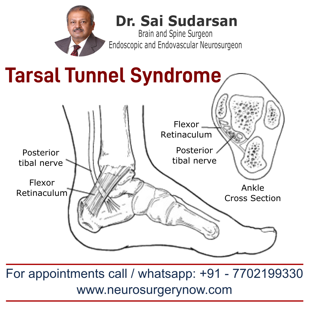 Tarsal Tunnel Syndrome